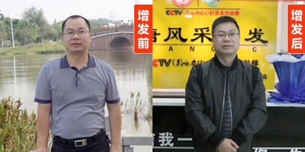 天生頭發(fā)稀少怎么變濃密？補發(fā)真的管用嗎