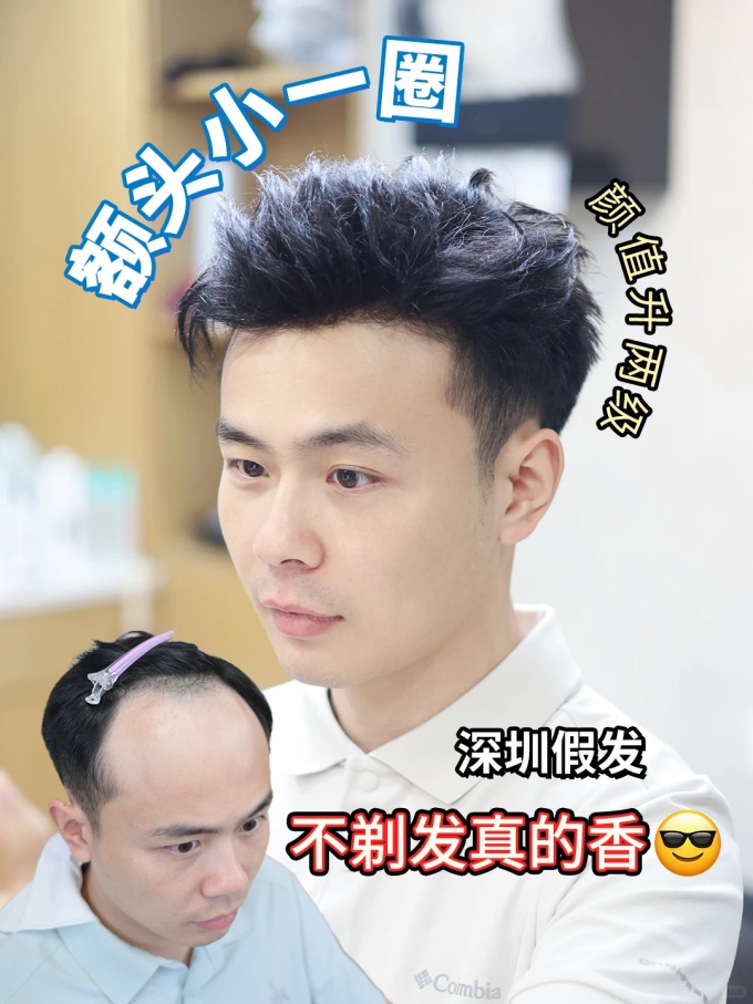 深圳假發(fā),發(fā)際線后退 \