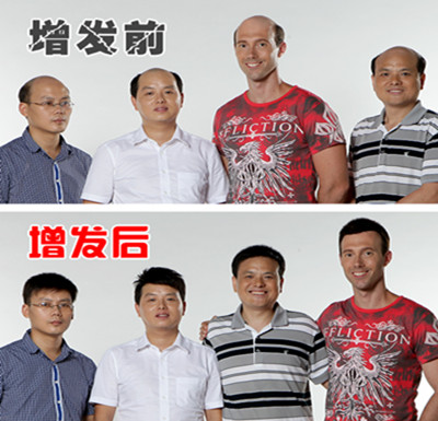 時(shí)光匆匆過，頭發(fā)脫了禿了怎么辦？