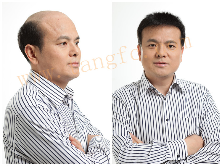 北京織發(fā)補發(fā)哪家好？怎么收費？